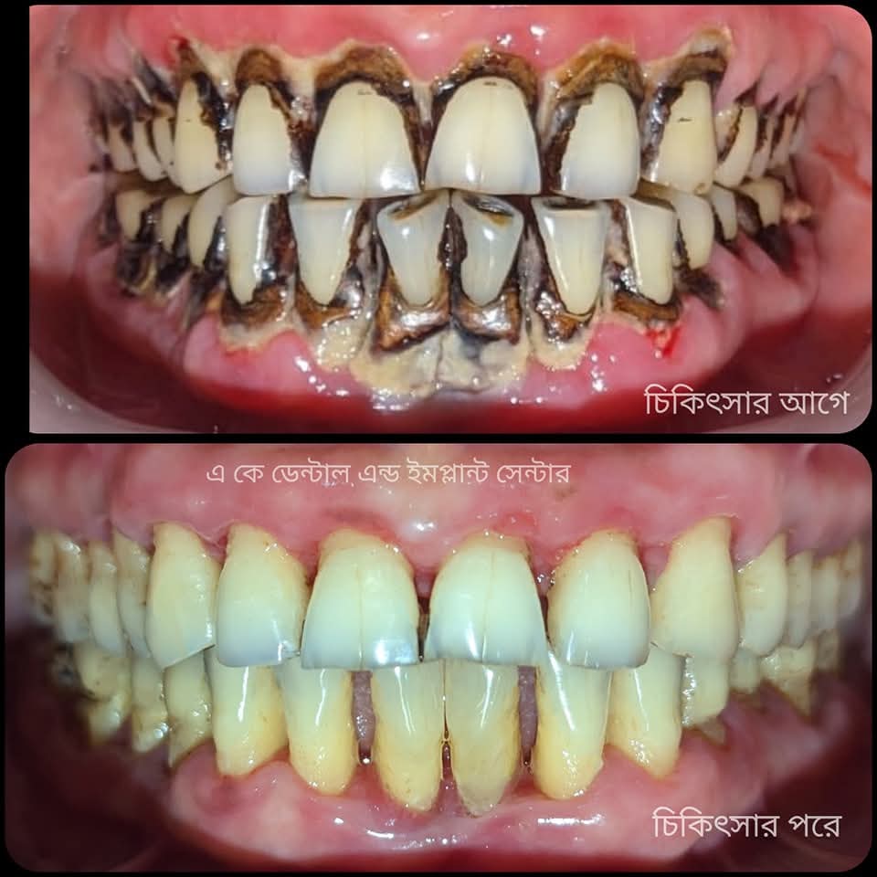 Before treatment - স্কেলিং ও পলিশিং